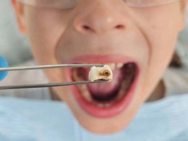 Best Emergency Dentist for Lost Fillings or Crowns in Mountain City, TN